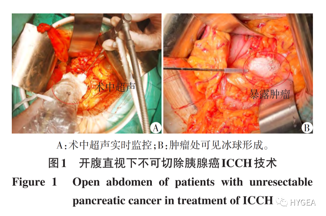 【科研资讯】术中冷冻消融和冷热复合消融治疗不可切除胰腺癌的临床研究